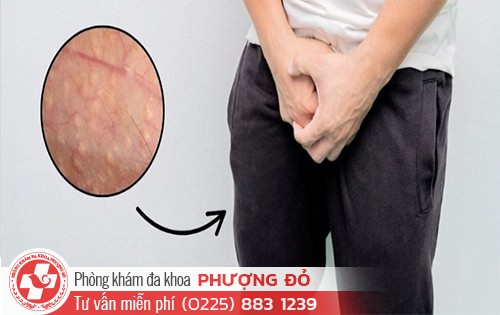 Cách phân biệt hạt Fordyce và sùi mào gà