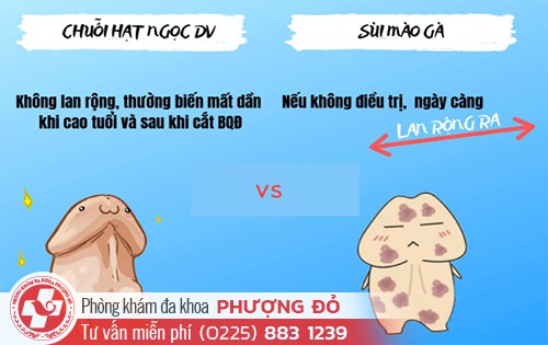 Cách phân biệt sùi mào gà và chuỗi hạt ngọc dương vật