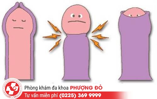 Hẹp bao quy đầu khiến dương vật bị ngắn nhỏ