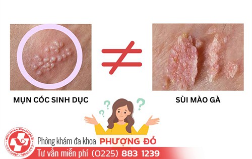Mụn cóc và sùi mào gà có giống nhau không?