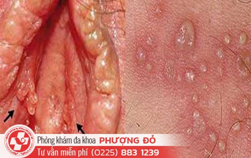Mụn cóc và sùi mào gà