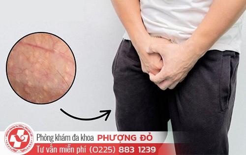 Phân biệt hạt Fordyce và sùi mào gà