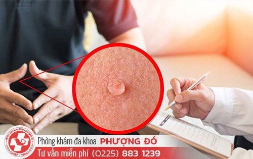 Sùi mào gà và hạt Fordyce