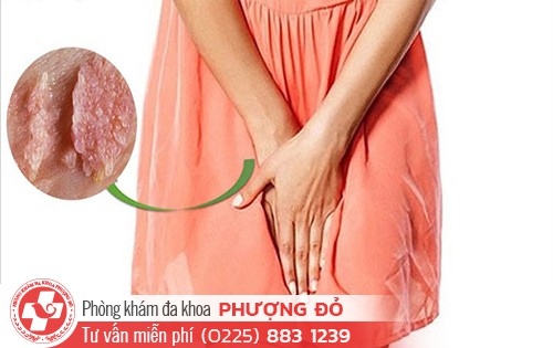 Phụ nữ có bị sùi mào gà không?